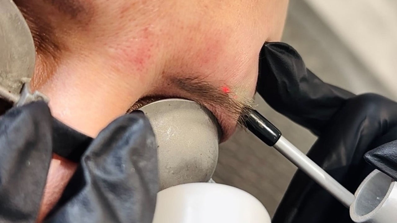 b8150bc3-478b-4d03-8add-d8067e616da7-harleyskinandlaser-gb-england-stoke-on-trent-porthill-fresha-5426146