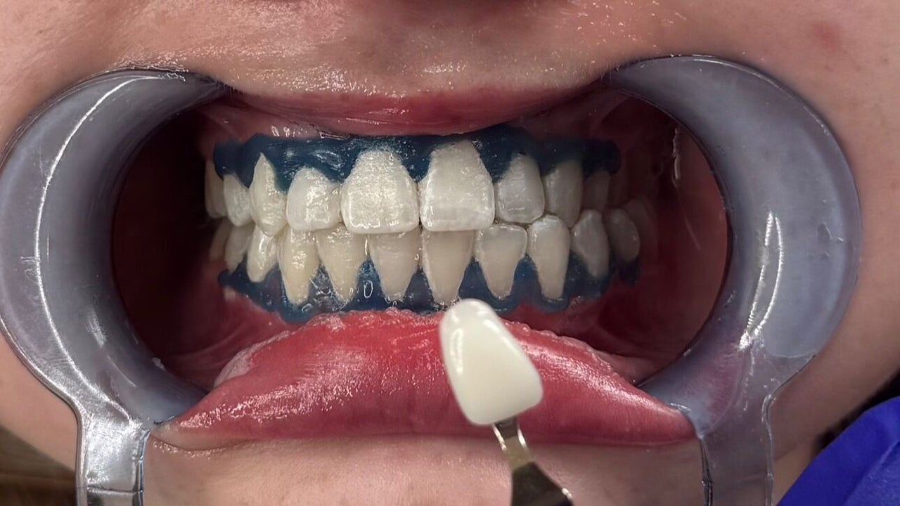 092d1c79-54d4-4b7b-b870-97c84c4d8915-thedermacliniccheshire-gb-england-hyde-geecross-fresha-3707906