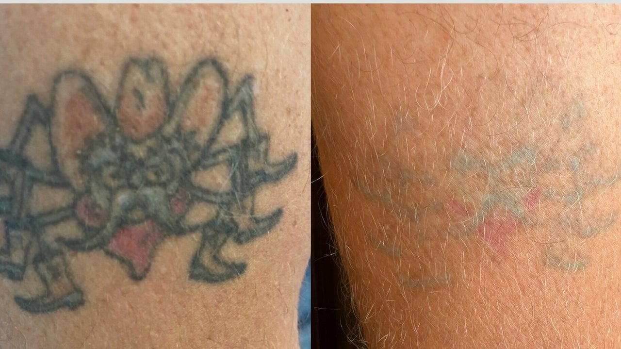 385d8d27-c48d-4543-9f06-d315849fe722-rachelberrypmulaserandcosmetictattoo-gb-england-huddersfield-aspley-fresha-9963723