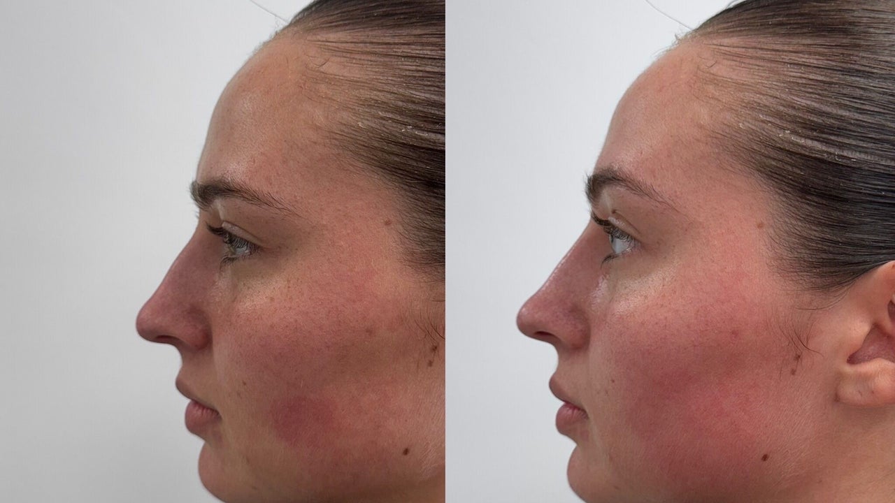 5ab3a546-33ca-48c7-9589-2a8fbfffe023-accentuateaesthetics-gb-england-wymondham-fresha-8100481