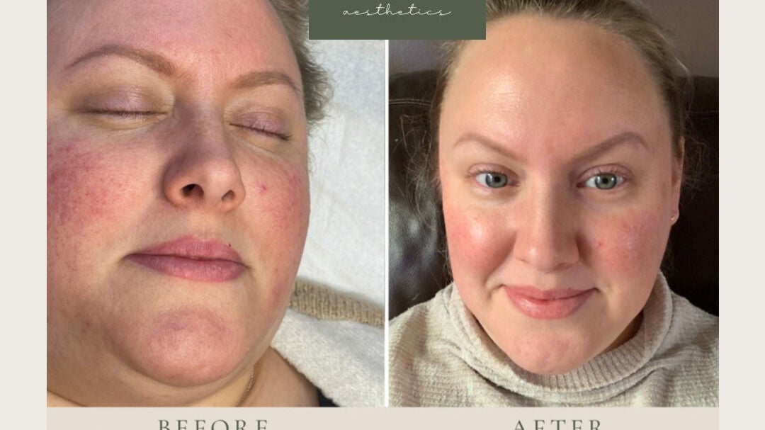 c3207e26-6de8-4af5-b7a0-f61980ebfb3c-emaestheticsbishopsstortford-gb-england-greathallingbury-fresha-2570851